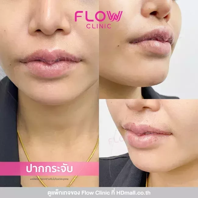 รีวิว ผ่าตัดทำปากกระจับ ที่ Flow Clinic