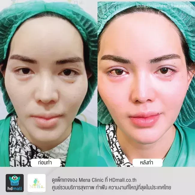 รีวิว ทำตาสองชั้นแบบกรีดยาว พร้อมตกแต่งไขมัน ที่ Mena Clinic