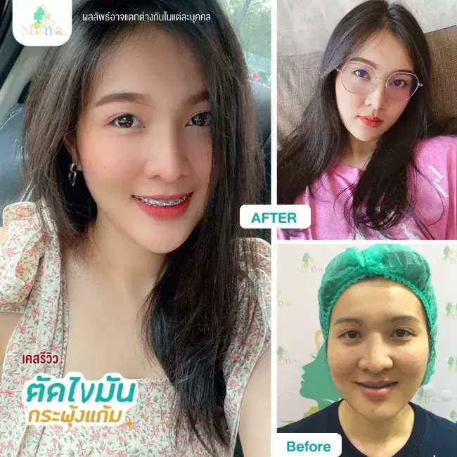 Before After รีวิว ตัดไขมันกระพุ้งแก้ม ที่ Mena Clinic