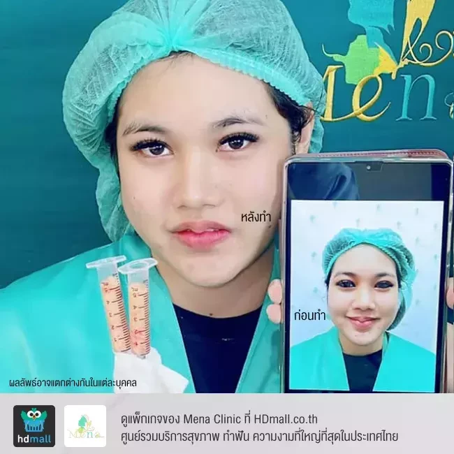 Before After รีวิว ตัดไขมันกระพุ้งแก้ม ที่ Mena Clinic