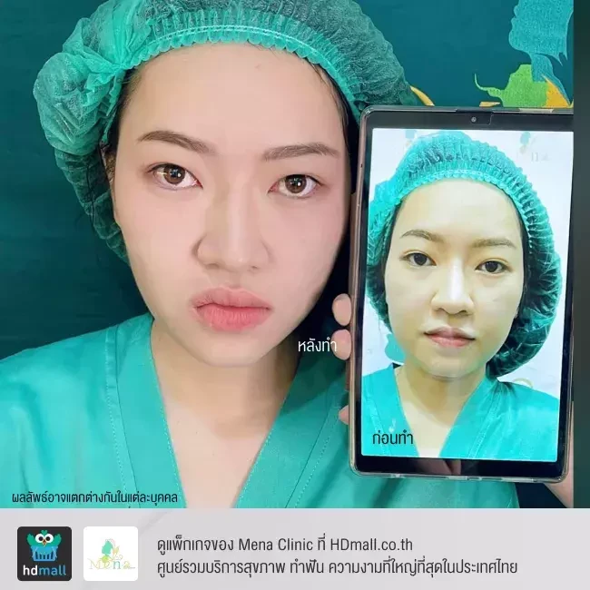 Before After รีวิว ตัดไขมันกระพุ้งแก้ม ที่ Mena Clinic
