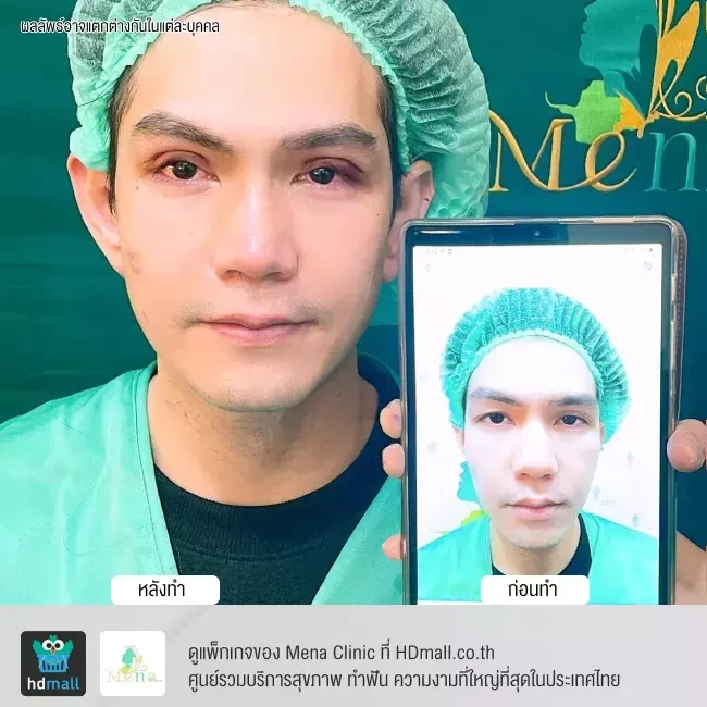 รีวิว ทำตาสองชั้นแบบกรีดยาว พร้อมตกแต่งไขมัน ที่ Mena Clinic