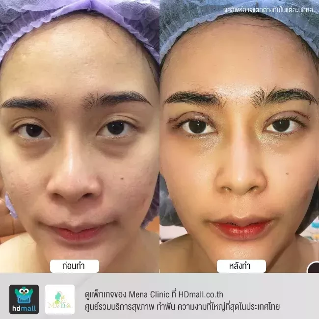 รีวิว ทำตาสองชั้นแบบกรีดยาว พร้อมตกแต่งไขมัน ที่ Mena Clinic