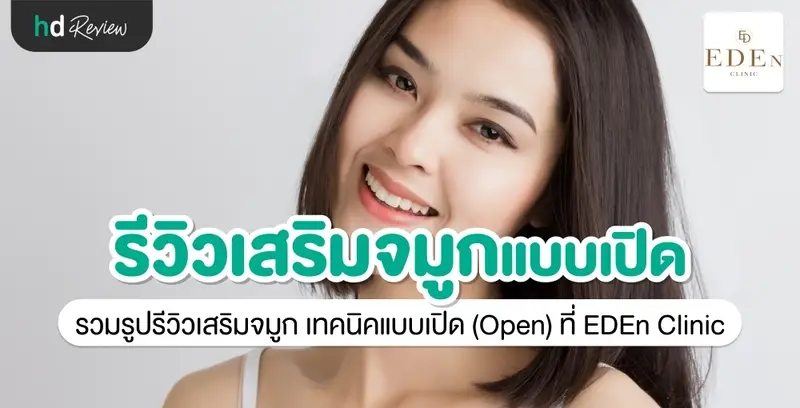 รีวิว เสริมจมูกแบบ Open เชียงใหม่ ที่ E-Den Clinic