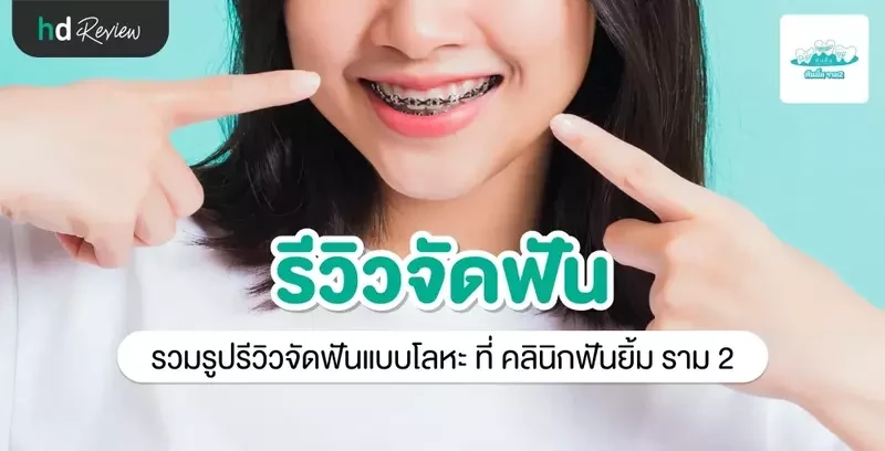 รีวิว จัดฟันแบบโลหะ ที่ คลินิกฟันยิ้ม ราม 2