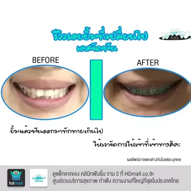 รีวิว จัดฟันแบบโลหะ ที่ คลินิกฟันยิ้ม ราม 2