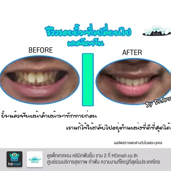 รีวิว จัดฟันแบบโลหะ ที่ คลินิกฟันยิ้ม ราม 2