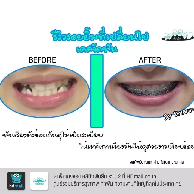 รีวิว จัดฟันแบบโลหะ ที่ คลินิกฟันยิ้ม ราม 2