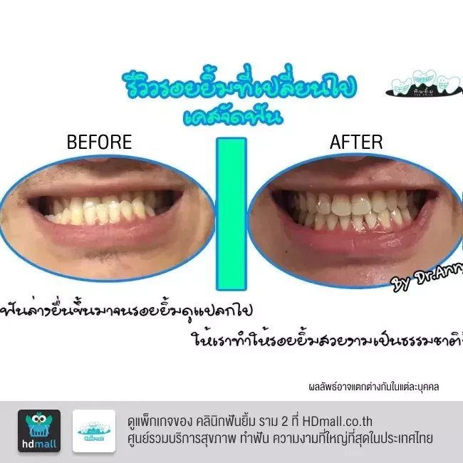 รีวิว จัดฟันแบบโลหะ ที่ คลินิกฟันยิ้ม ราม 2
