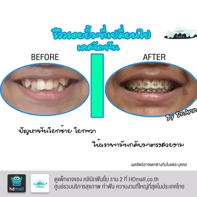 รีวิว จัดฟันแบบโลหะ ที่ คลินิกฟันยิ้ม ราม 2