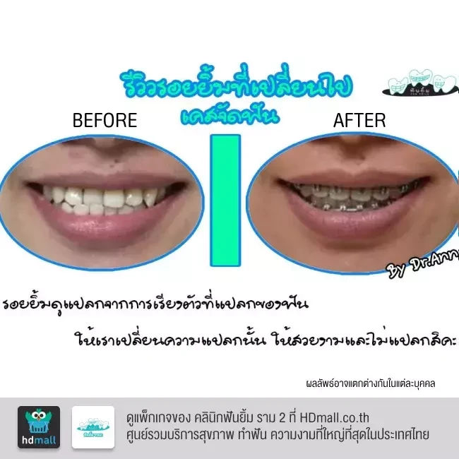 รีวิว จัดฟันแบบโลหะ ที่ คลินิกฟันยิ้ม ราม 2