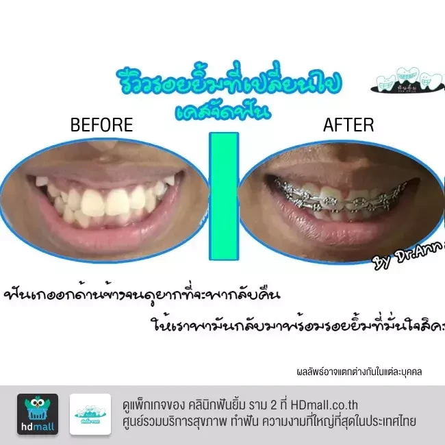 รีวิว จัดฟันแบบโลหะ ที่ คลินิกฟันยิ้ม ราม 2