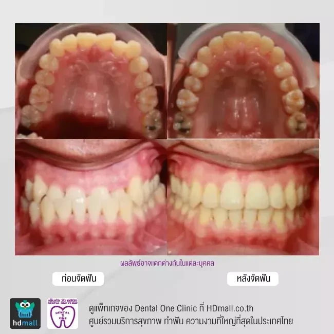 รีวิว จัดฟันแบบโลหะ ที่ Dental One Clinic