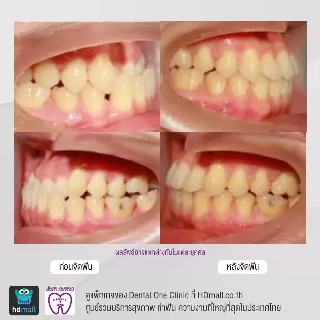 รีวิว จัดฟันแบบโลหะ ที่ Dental One Clinic