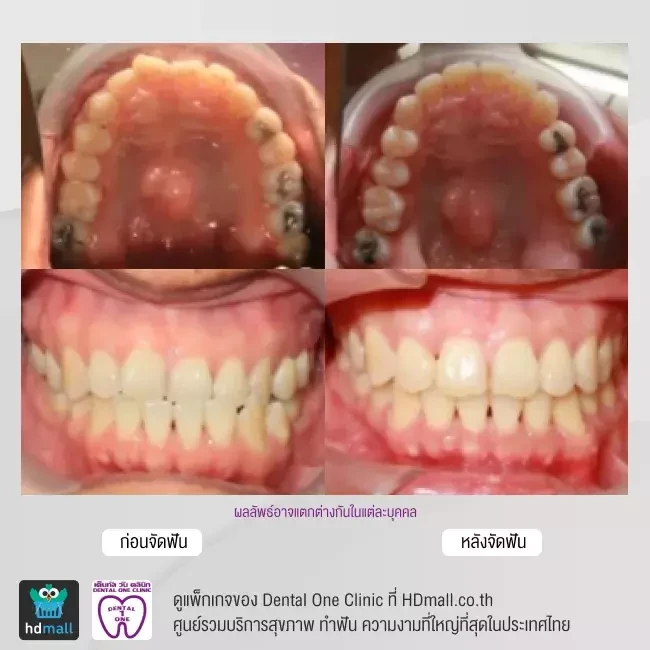 รีวิว จัดฟันแบบโลหะ ที่ Dental One Clinic