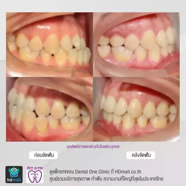 รีวิว จัดฟันแบบโลหะ ที่ Dental One Clinic