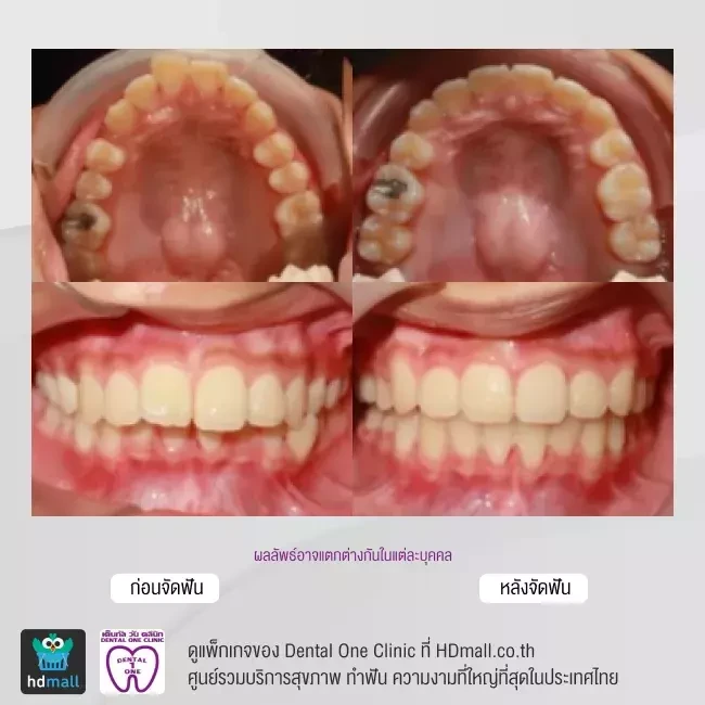 รีวิว จัดฟันแบบโลหะ ที่ Dental One Clinic
