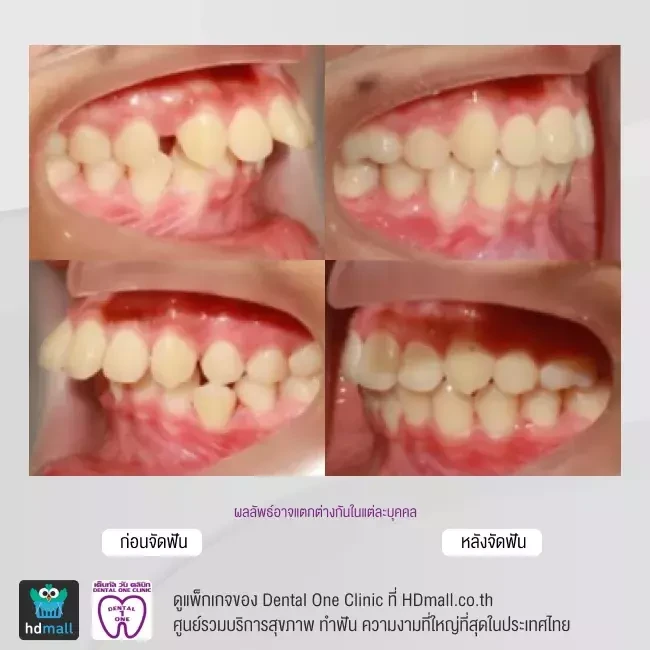 รีวิว จัดฟันแบบโลหะ ที่ Dental One Clinic