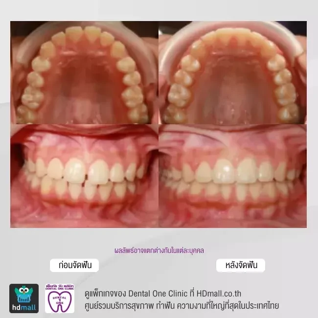 รีวิว จัดฟันแบบโลหะ ที่ Dental One Clinic
