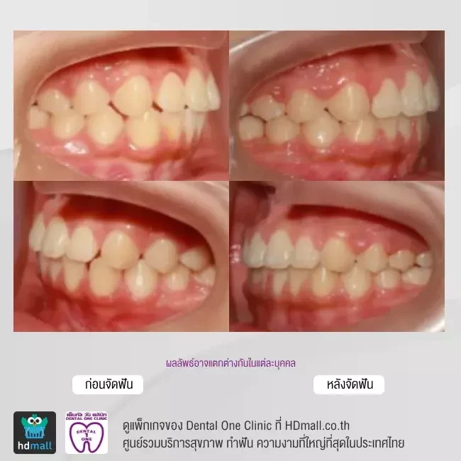 รีวิว จัดฟันแบบโลหะ ที่ Dental One Clinic
