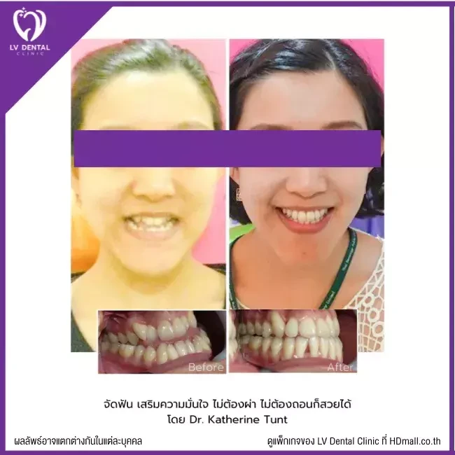 รีวิว จัดฟัน ที่ LV Dental Clinic