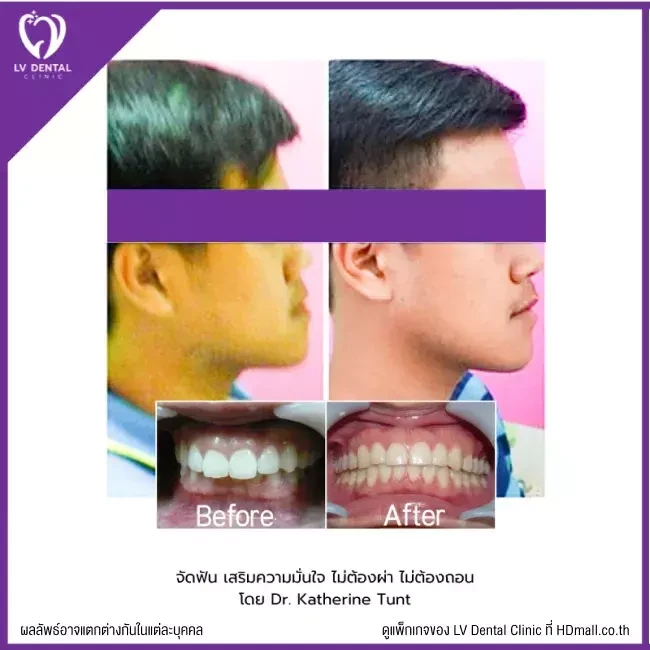 รีวิว จัดฟัน ที่ LV Dental Clinic