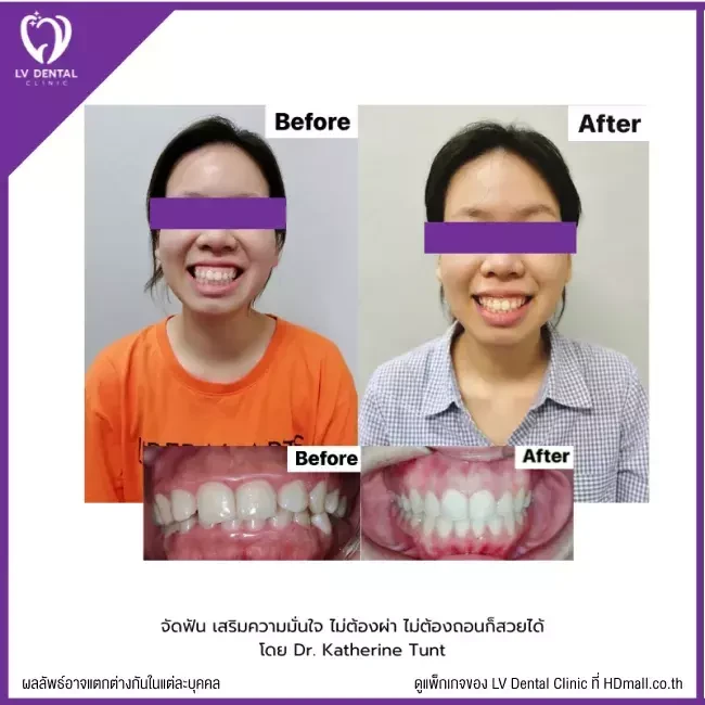 รีวิว จัดฟัน ที่ LV Dental Clinic