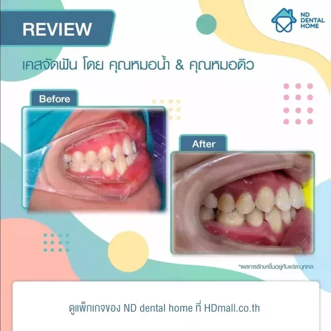 รีวิว จัดฟัน ที่ ND dental home