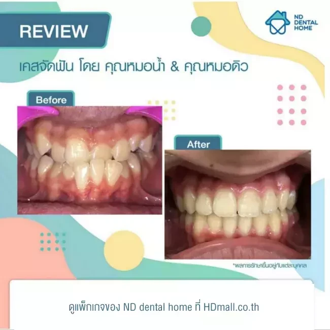 รีวิว จัดฟัน ที่ ND dental home