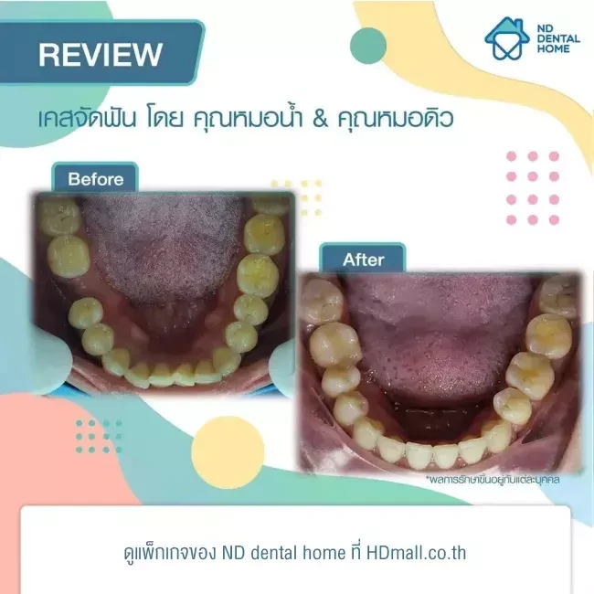 รีวิว จัดฟัน ที่ ND dental home