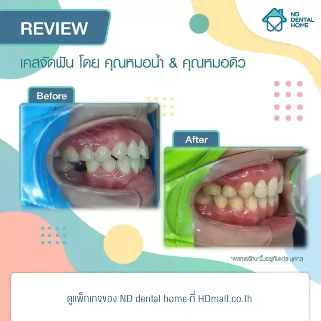 รีวิว จัดฟัน ที่ ND dental home