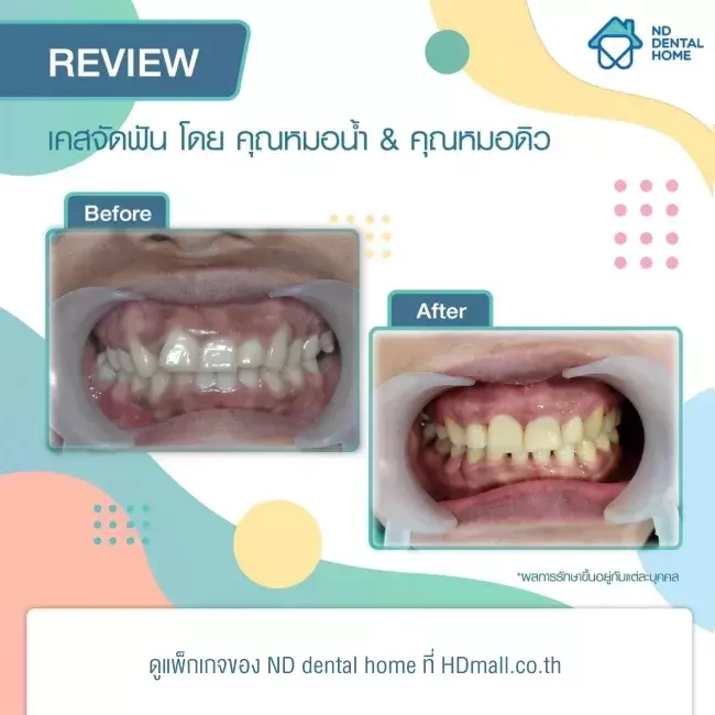 รีวิว จัดฟัน ที่ ND dental home