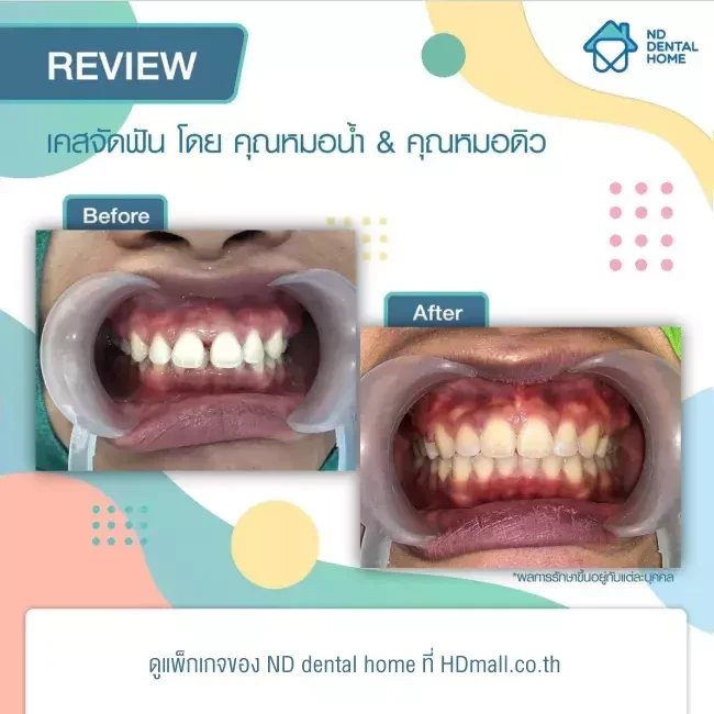 รีวิว จัดฟัน ที่ ND dental home