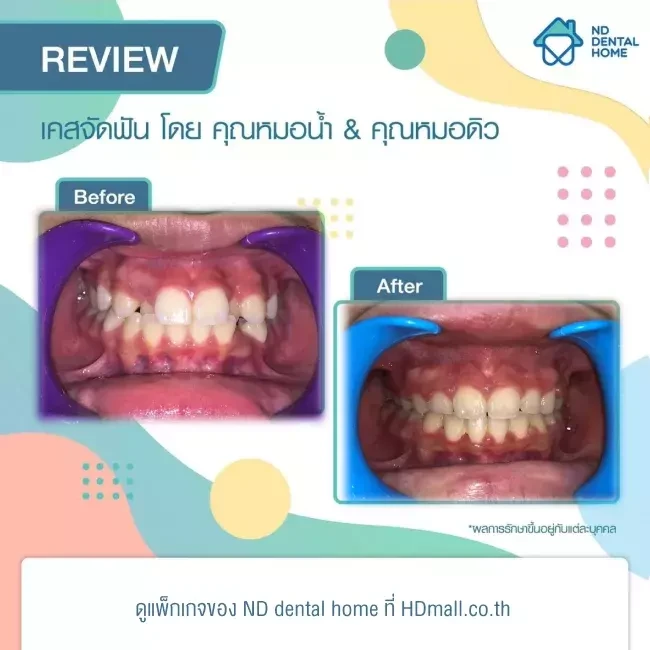 รีวิว จัดฟัน ที่ ND dental home