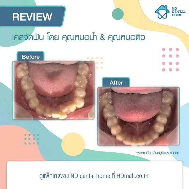 รีวิว จัดฟัน ที่ ND dental home