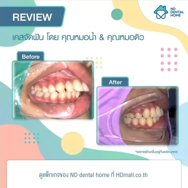รีวิว จัดฟัน ที่ ND dental home