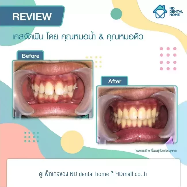 รีวิว จัดฟัน ที่ ND dental home