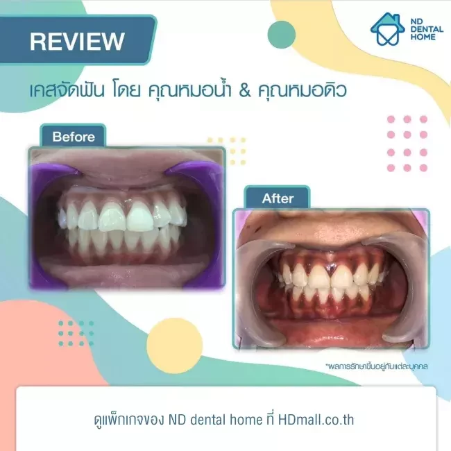 รีวิว จัดฟัน ที่ ND dental home