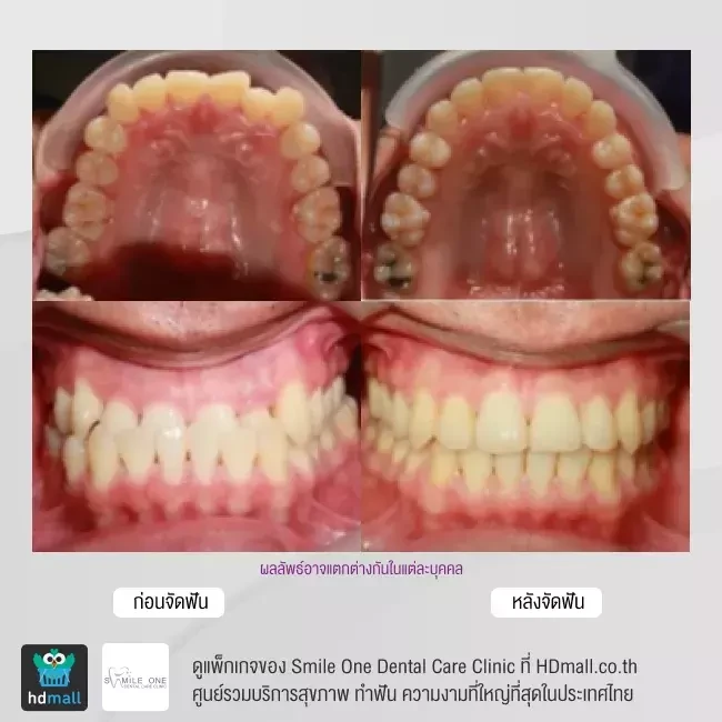 รีวิว จัดฟันแบบโลหะ ที่ Smile One Dental Care Clinic