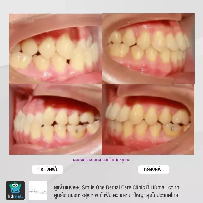 รีวิว จัดฟันแบบโลหะ ที่ Smile One Dental Care Clinic