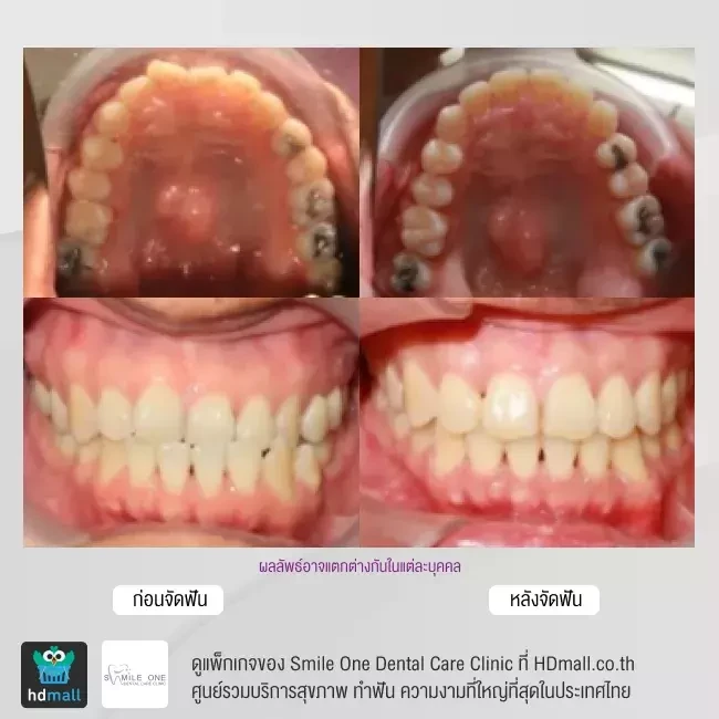 รีวิว จัดฟันแบบโลหะ ที่ Smile One Dental Care Clinic