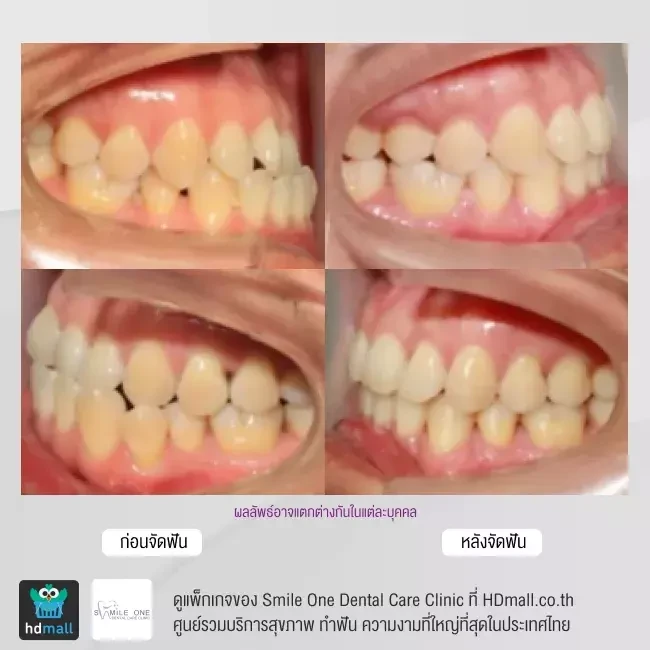รีวิว จัดฟันแบบโลหะ ที่ Smile One Dental Care Clinic