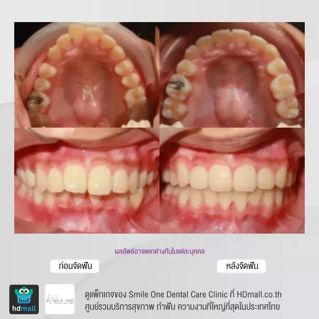 รีวิว จัดฟันแบบโลหะ ที่ Smile One Dental Care Clinic