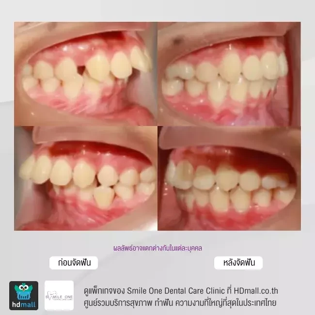 รีวิว จัดฟันแบบโลหะ ที่ Smile One Dental Care Clinic