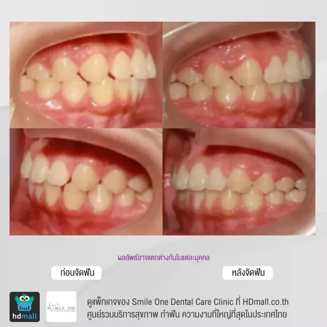 รีวิว จัดฟันแบบโลหะ ที่ Smile One Dental Care Clinic