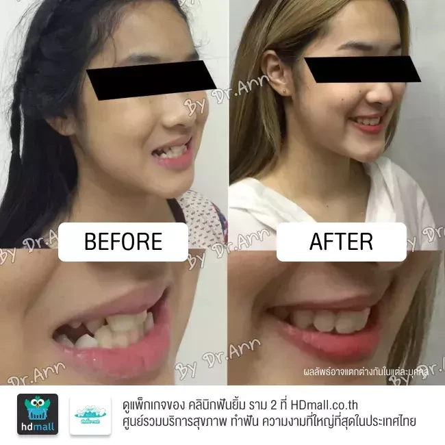 รีวิว จัดฟัน Smart Clip ที่ คลินิกฟันยิ้ม ราม 2