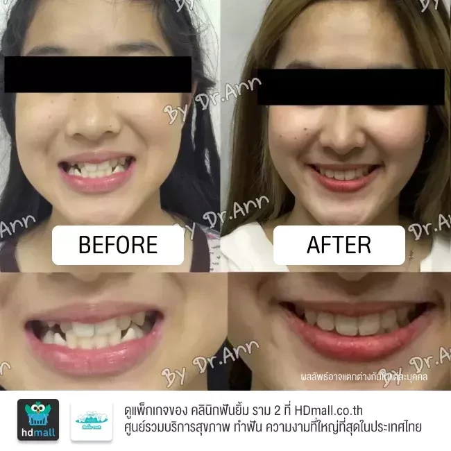 รีวิว จัดฟัน Smart Clip ที่ คลินิกฟันยิ้ม ราม 2