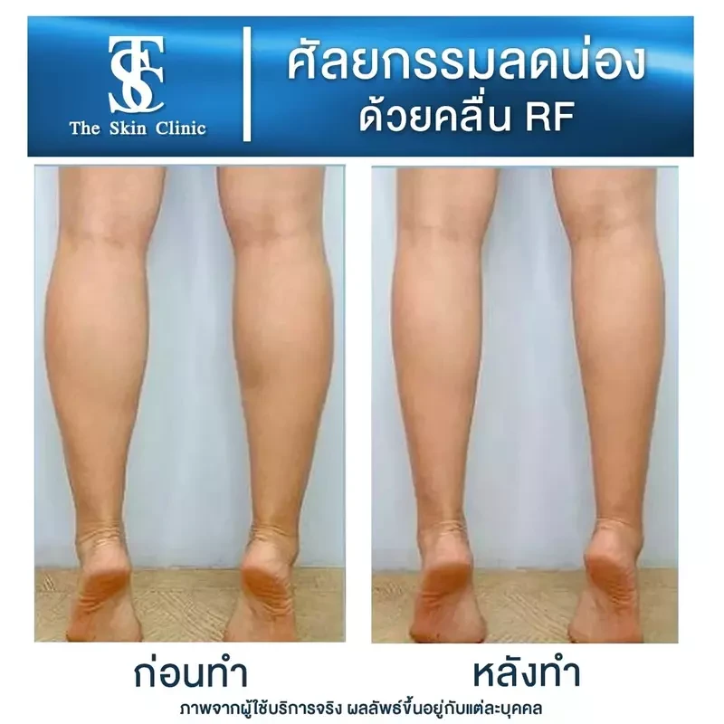 รีวิว ลดน่องด้วยคลื่น RF ที่ The Skin Clinic