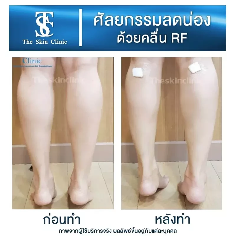 รีวิว ลดน่องด้วยคลื่น RF ที่ The Skin Clinic