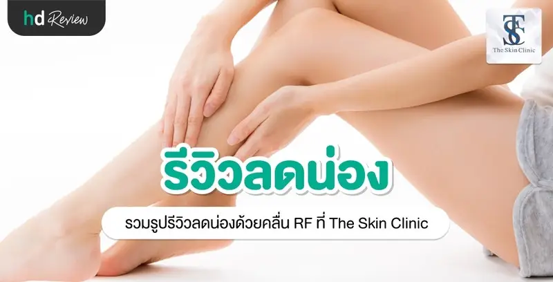 รีวิว ลดน่องด้วยคลื่น RF ที่ The Skin Clinic